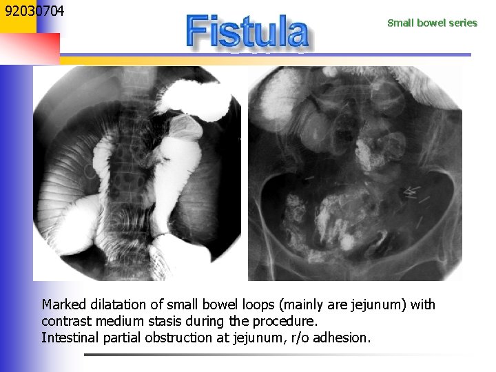 92030704 Small bowel series Marked dilatation of small bowel loops (mainly are jejunum) with