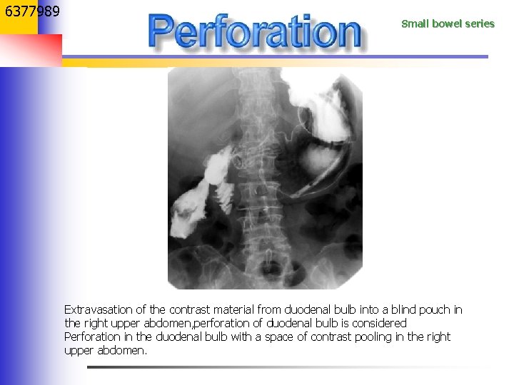 6377989 Small bowel series Extravasation of the contrast material from duodenal bulb into a