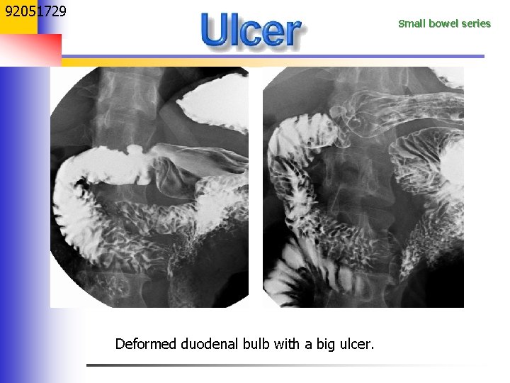 92051729 Small bowel series Deformed duodenal bulb with a big ulcer. 