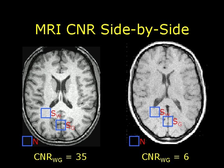 MRI CNR Side-by-Side SW SW SG SG N N CNRWG = 35 CNRWG =
