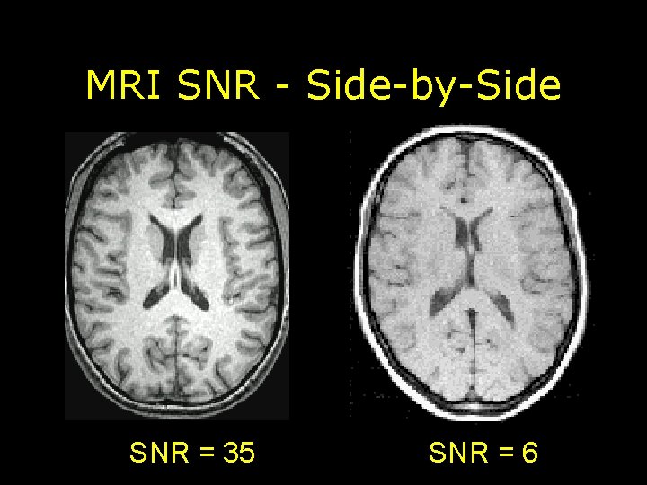 MRI SNR - Side-by-Side SNR = 35 SNR = 6 