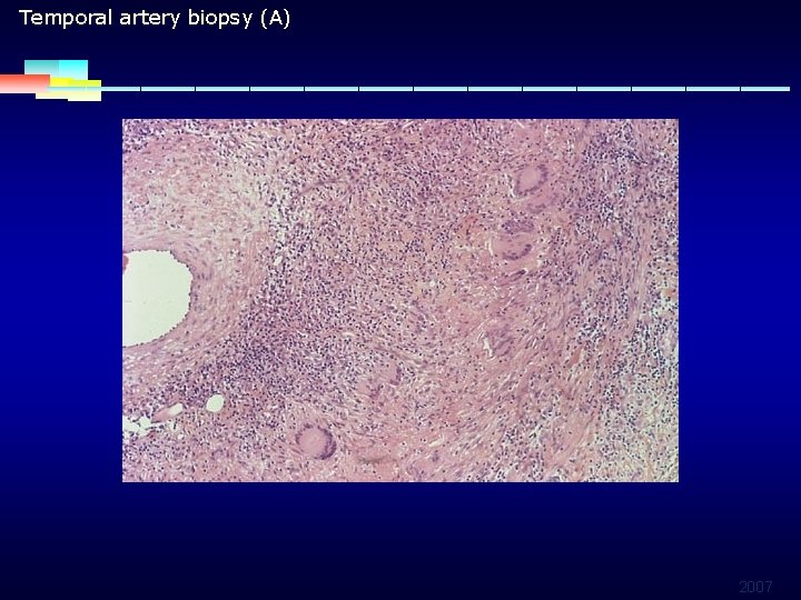 Temporal artery biopsy (A) 2007 