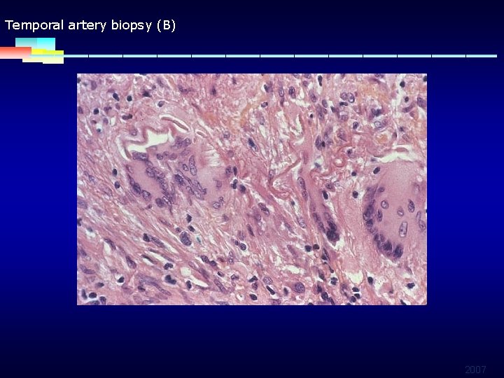 Temporal artery biopsy (B) 2007 