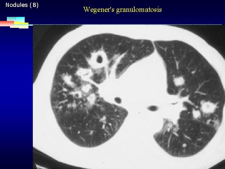 Nodules (B) Wegener's granulomatosis 2007 