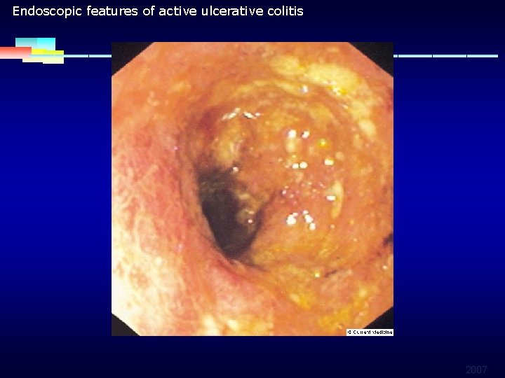 Endoscopic features of active ulcerative colitis 2007 