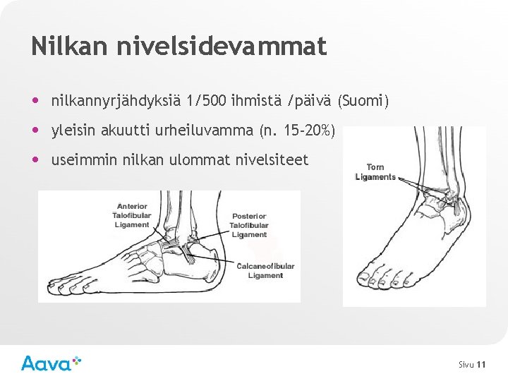 Nilkan nivelsidevammat • nilkannyrjähdyksiä 1/500 ihmistä /päivä (Suomi) • yleisin akuutti urheiluvamma (n. 15