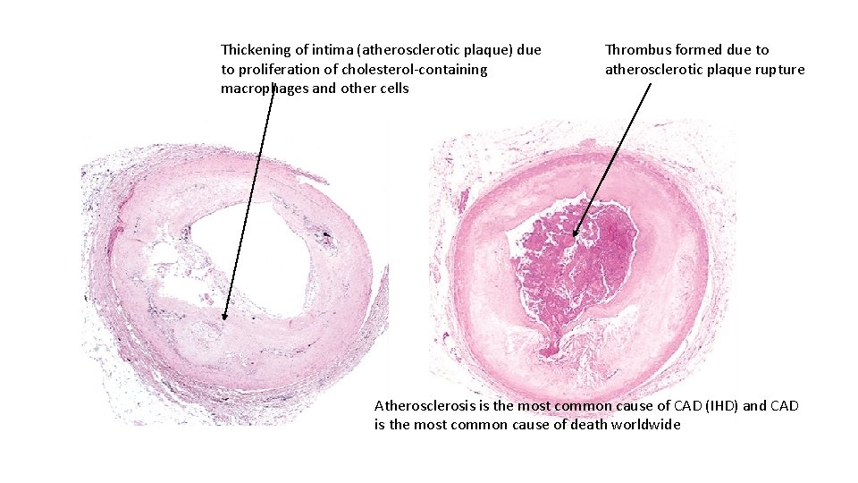 Thickening of intima (atherosclerotic plaque) due to proliferation of cholesterol-containing macrophages and other cells