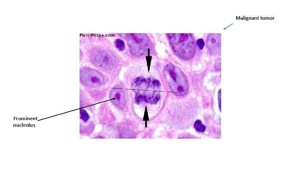 Malignant tumor Prominent nucleolus 