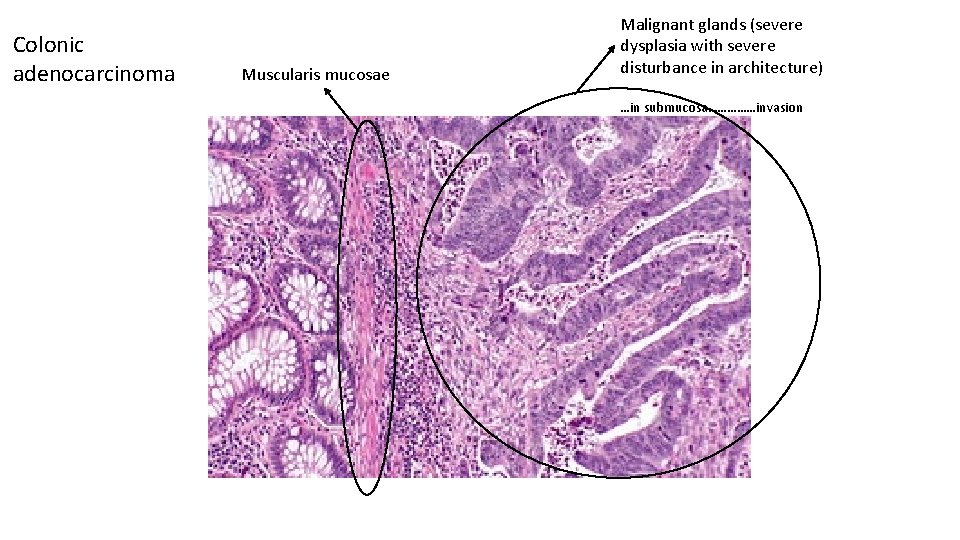 Colonic adenocarcinoma Muscularis mucosae Malignant glands (severe dysplasia with severe disturbance in architecture) …in