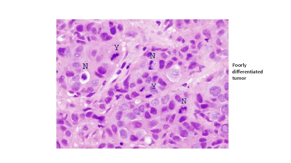 Poorly differentiated tumor 