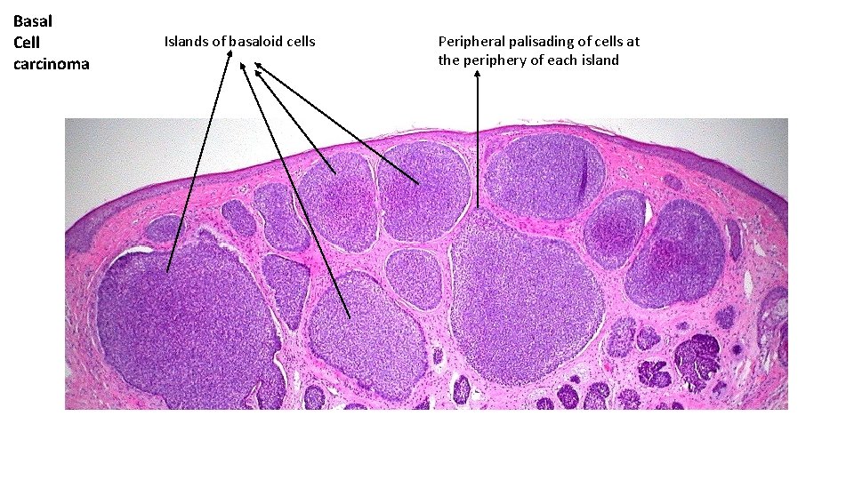 Basal Cell carcinoma Islands of basaloid cells Peripheral palisading of cells at the periphery