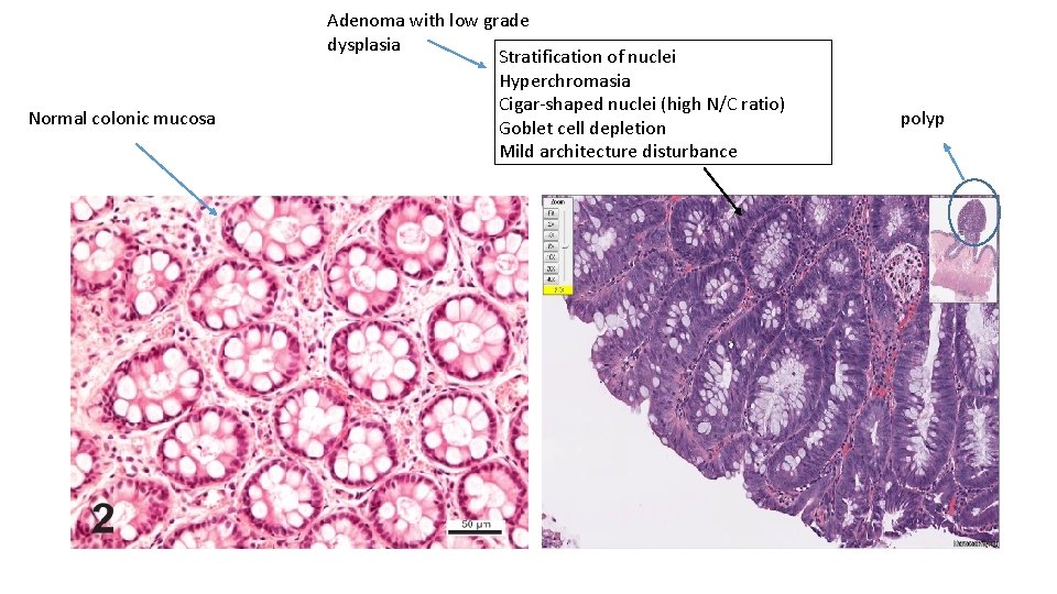 Normal colonic mucosa Adenoma with low grade dysplasia Stratification of nuclei Hyperchromasia Cigar-shaped nuclei