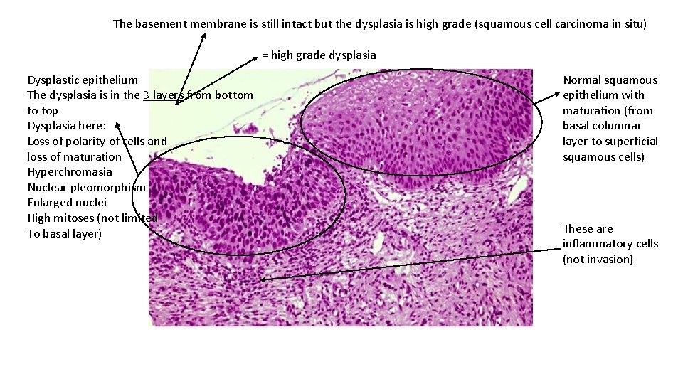 The basement membrane is still intact but the dysplasia is high grade (squamous cell