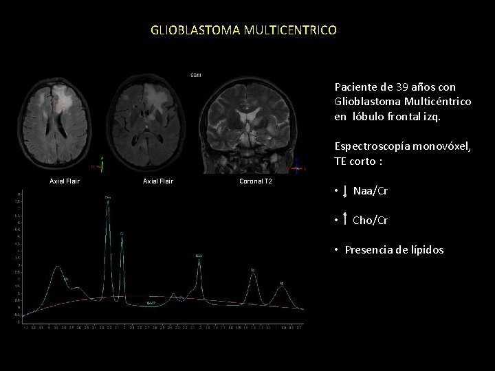 GLIOBLASTOMA MULTICENTRICO Paciente de 39 años con Glioblastoma Multicéntrico en lóbulo frontal izq. Espectroscopía