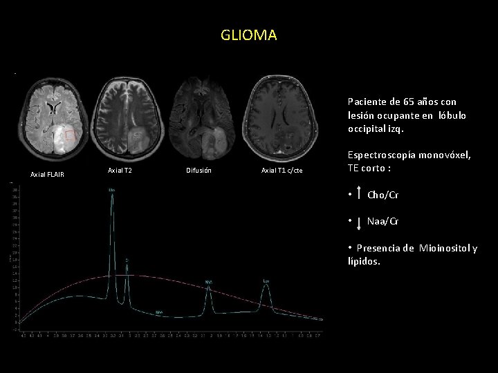 GLIOMA Paciente de 65 años con lesión ocupante en lóbulo occipital izq. Axial FLAIR