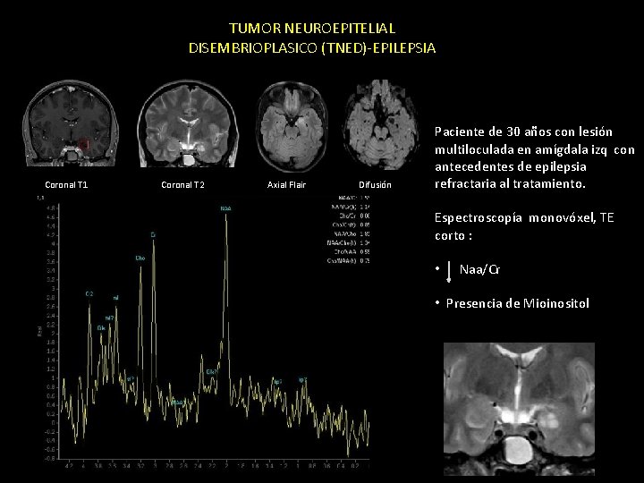 TUMOR NEUROEPITELIAL DISEMBRIOPLASICO (TNED)-EPILEPSIA Coronal T 1 Coronal T 2 Axial Flair Difusión Paciente