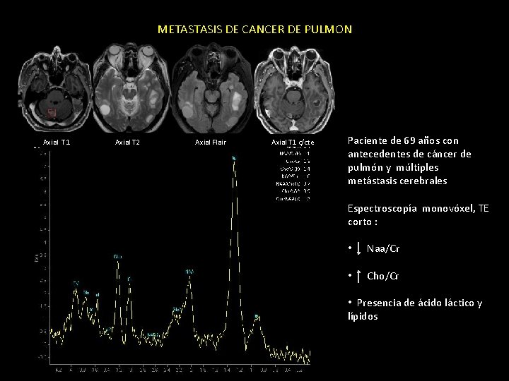 METASTASIS DE CANCER DE PULMON Axial T 1 Axial T 2 Axial Flair Axial