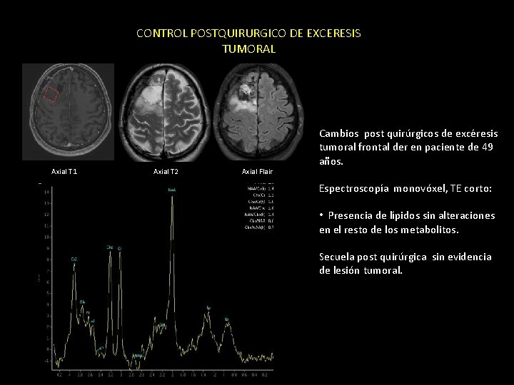 CONTROL POSTQUIRURGICO DE EXCERESIS TUMORAL Axial T 1 Axial T 2 Axial Flair Cambios