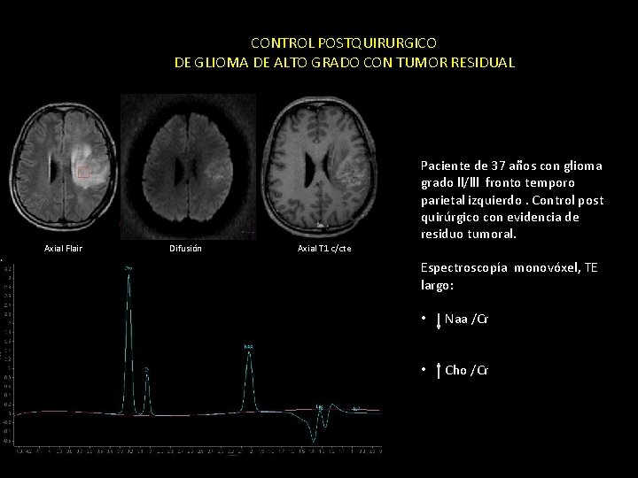 CONTROL POSTQUIRURGICO DE GLIOMA DE ALTO GRADO CON TUMOR RESIDUAL Paciente de 37 años