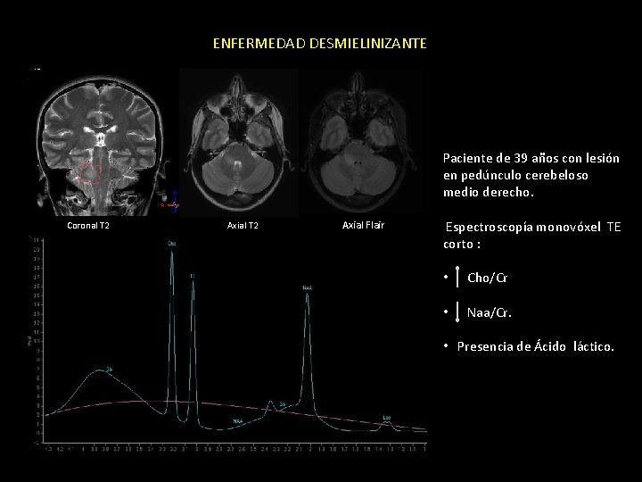 ENFERMEDAD DESMIELINIZANTE Paciente de 39 años con lesión en pedúnculo cerebeloso medio derecho. Coronal