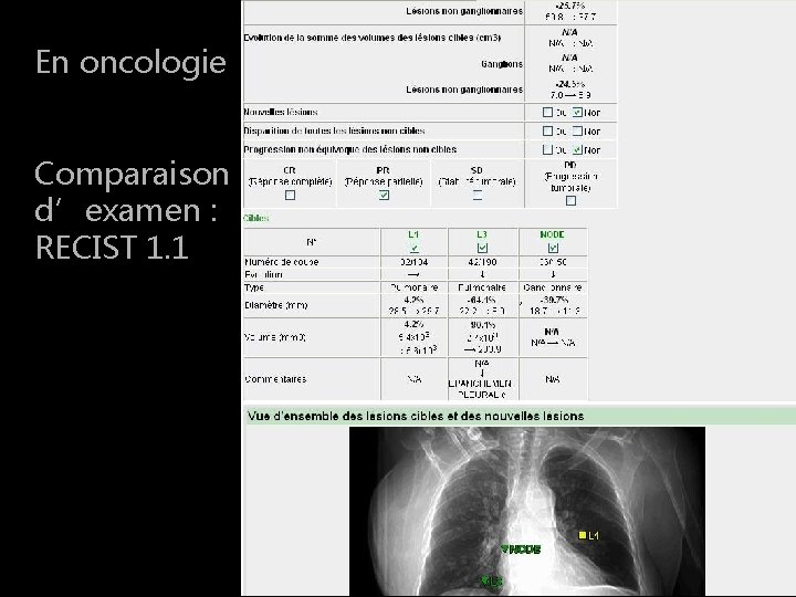 En oncologie Compte rendu RECIST 1. 1 Comparaison d’examen : RECIST 1. 1 En oncologie Compte rendu RECIST 1. 1 Comparaison d’examen : RECIST 1. 1