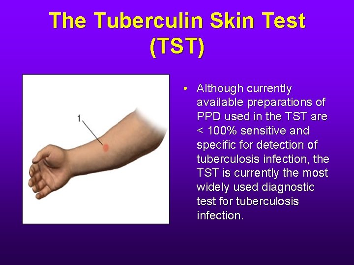 The Tuberculin Skin Test (TST) • Although currently available preparations of PPD used in