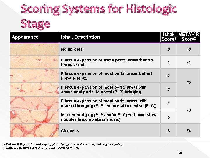 Scoring Systems for Histologic Stage Appearance Ishak Description Ishak METAVIR Score 1 Score 2