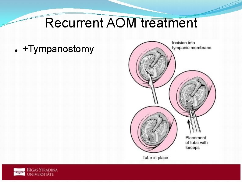 Recurrent AOM treatment +Tympanostomy Recurrent AOM treatment +Tympanostomy