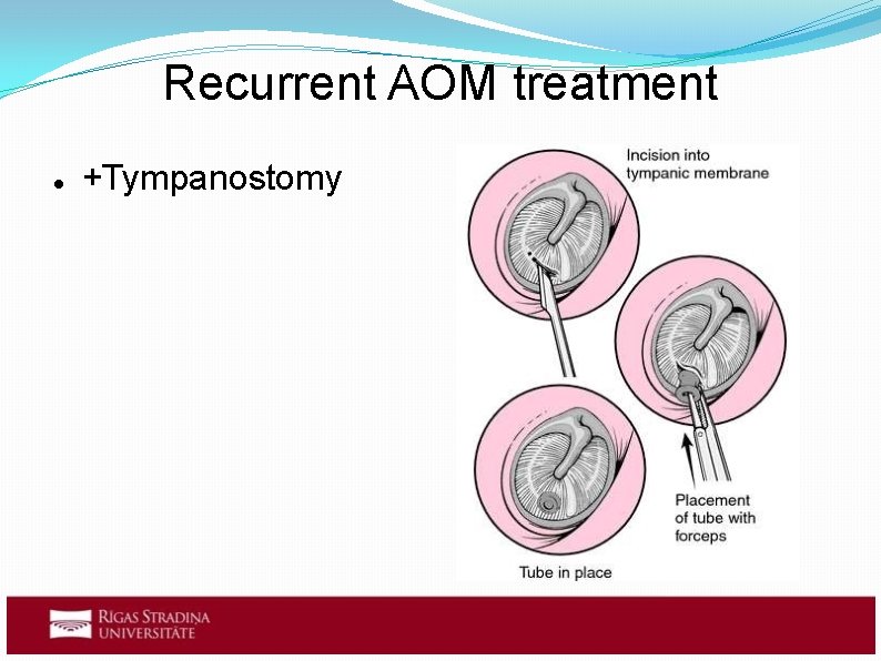 Recurrent AOM treatment +Tympanostomy 