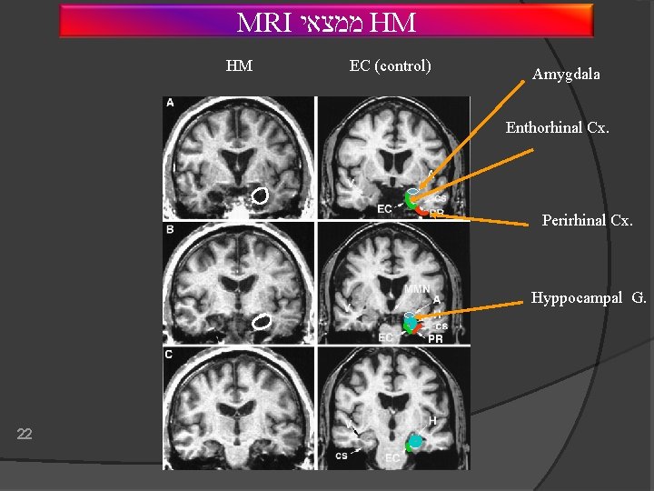 MRI ממצאי HM HM EC (control) Amygdala Enthorhinal Cx. Perirhinal Cx. Hyppocampal G. 22