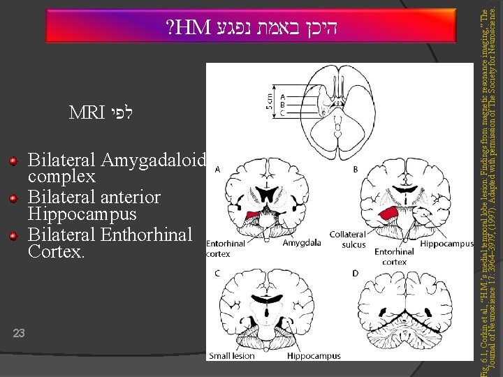 MRI לפי Bilateral Amygadaloid complex Bilateral anterior Hippocampus Bilateral Enthorhinal Cortex. 23 ig. 6.