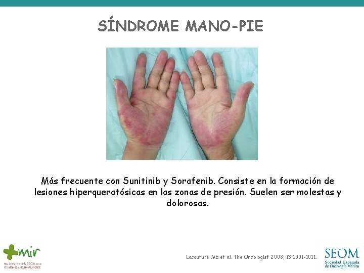SÍNDROME MANO-PIE Más frecuente con Sunitinib y Sorafenib. Consiste en la formación de lesiones