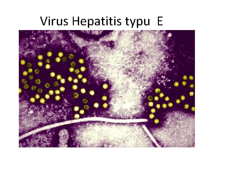 Virus Hepatitis typu E 