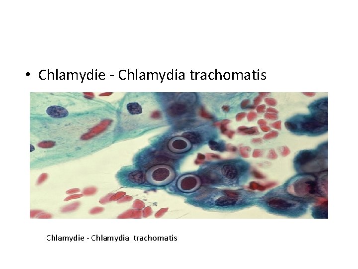  • Chlamydie - Chlamydia trachomatis 