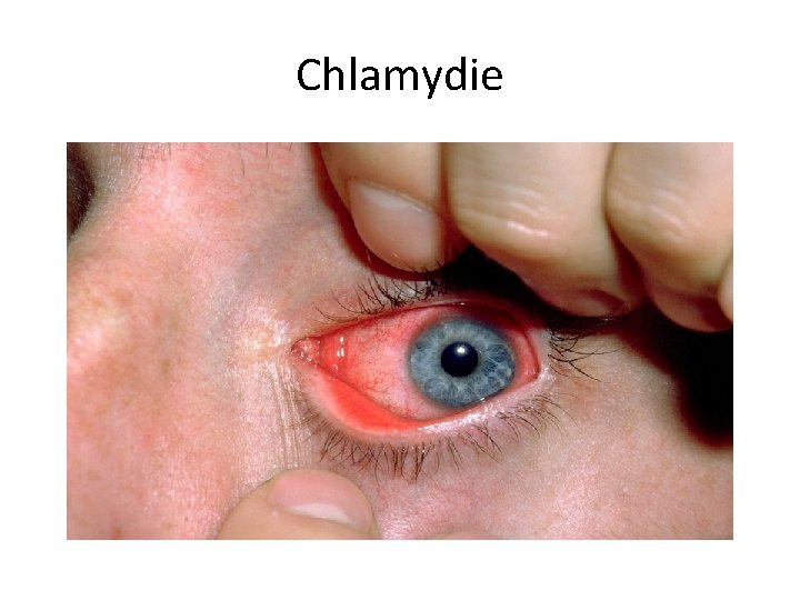 Chlamydie 