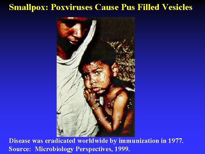 Smallpox: Poxviruses Cause Pus Filled Vesicles Disease was eradicated worldwide by immunization in 1977.