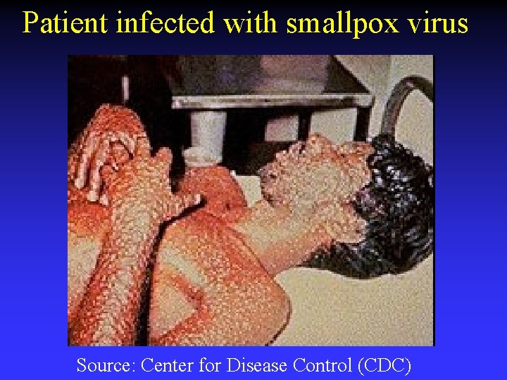 Patient infected with smallpox virus Source: Center for Disease Control (CDC) 