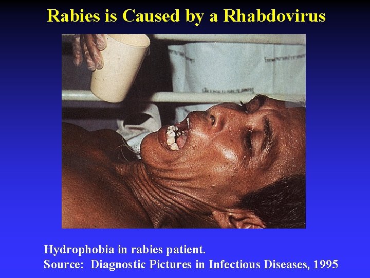 Rabies is Caused by a Rhabdovirus Hydrophobia in rabies patient. Source: Diagnostic Pictures in