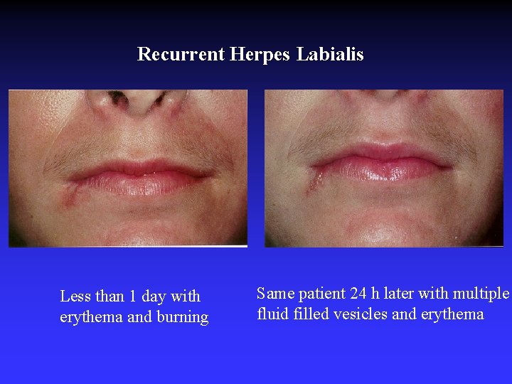 Recurrent Herpes Labialis Less than 1 day with erythema and burning Same patient 24