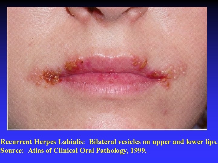 Recurrent Herpes Labialis: Bilateral vesicles on upper and lower lips. Source: Atlas of Clinical