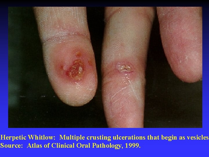Herpetic Whitlow: Multiple crusting ulcerations that begin as vesicles. Source: Atlas of Clinical Oral