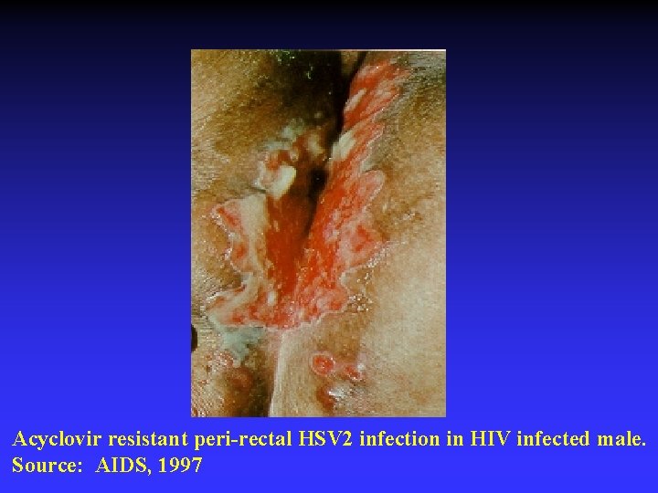 Acyclovir resistant peri-rectal HSV 2 infection in HIV infected male. Source: AIDS, 1997 