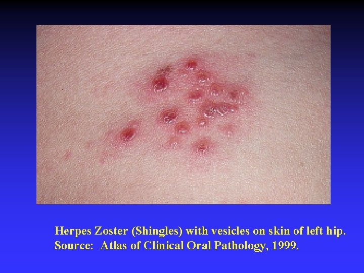 Herpes Zoster (Shingles) with vesicles on skin of left hip. Source: Atlas of Clinical