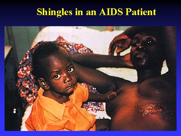 Shingles in an AIDS Patient 