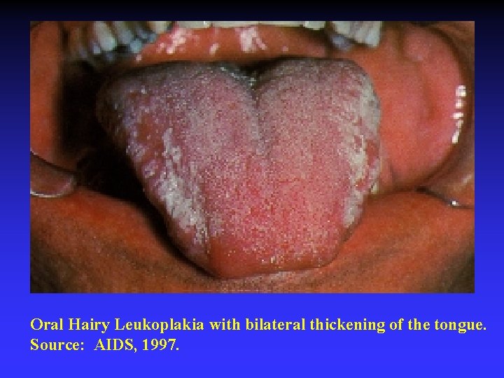 Oral Hairy Leukoplakia with bilateral thickening of the tongue. Source: AIDS, 1997. 