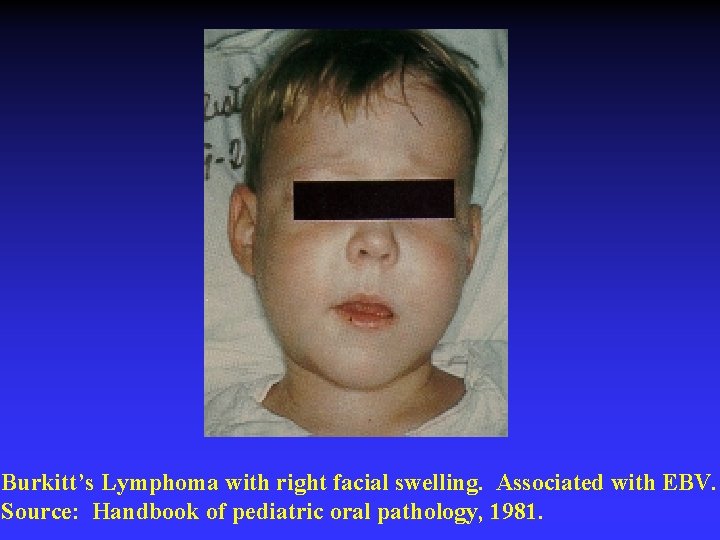 Burkitt’s Lymphoma with right facial swelling. Associated with EBV. Source: Handbook of pediatric oral