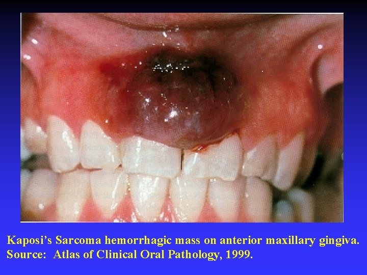 Kaposi’s Sarcoma hemorrhagic mass on anterior maxillary gingiva. Source: Atlas of Clinical Oral Pathology,