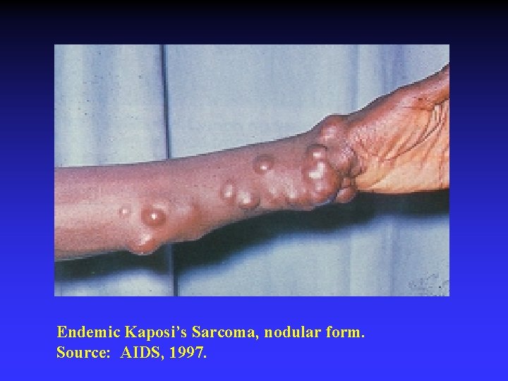 Endemic Kaposi’s Sarcoma, nodular form. Source: AIDS, 1997. 