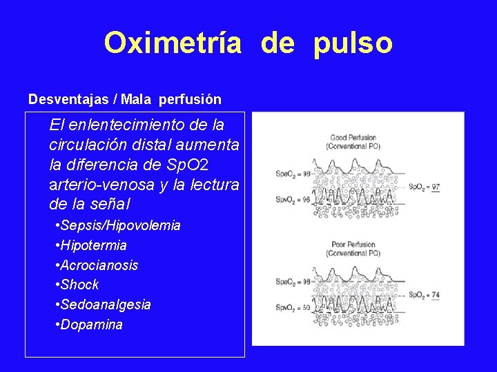 Oximetría de pulso Desventajas / Mala perfusión El enlentecimiento de la circulación distal aumenta