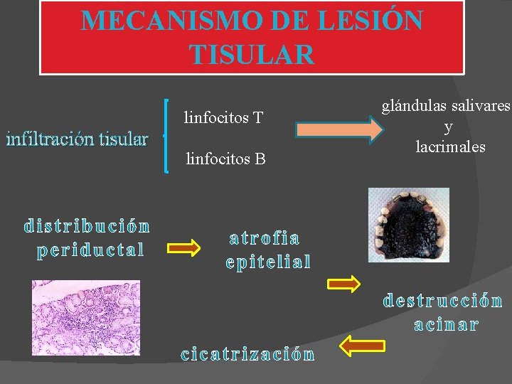 MECANISMO DE LESIÓN TISULAR linfocitos T infiltración tisular linfocitos B glándulas salivares y lacrimales